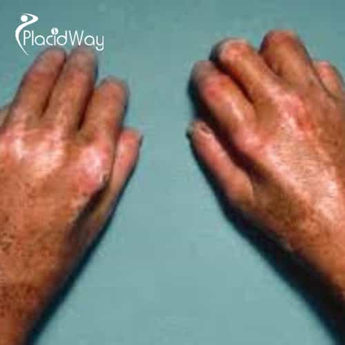 Scleroderma Doesn’t Define You: U.S. Patients Are Reclaiming Their Health with Stem Cells in Tijuana